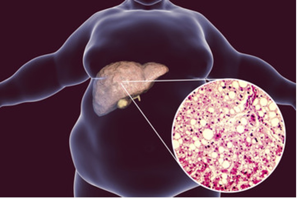 Fatty liver due to obesity.